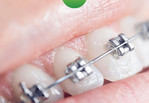 Niềng răng có những loại nào? Nên chọn loại nào, chi phí bao nhiêu